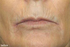 Lip Augmentation Implant width=
