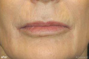 Lip Augmentation Implant Result Portland