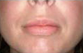 Lip Augmentation Implant