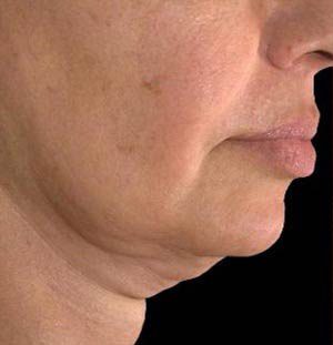 Ultherapy (Ultrasound Face-lift)