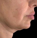 Ultherapy (Ultrasound Face-lift)