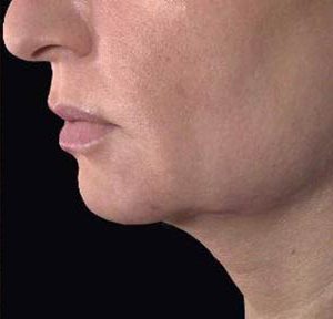 Ultherapy (Ultrasound Face-lift), Laser Treatments, Clackamas OR