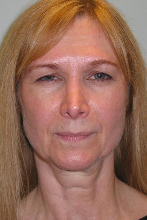 Facelift in Portland by Dr. James Chan