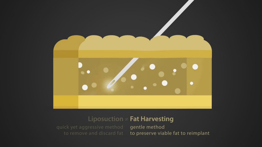 Fat Grafting vs Harvesting